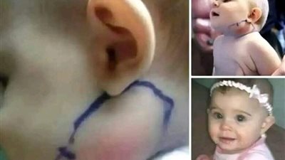 اعتقدت الأم أنها مجرد بثرة لكن عندما فتح الطبيب وسحبها صـ.ـدم الجميع بما رأوه