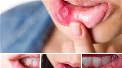 علاج قرح الفم في المنزل بـ4 خطوات بسيطة.. تخلص منها سريعا