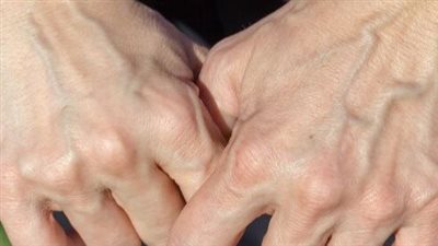 ظهور العروق البارزة في اليد على ماذا تدل؟ وكيفية علاجها؟