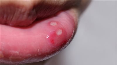 ما هي أسباب قرح الفم وأنواعها وكيف تحمي نفسك منها ؟