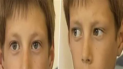 سخروا منه لأن أسنانه تشبه الأرنب