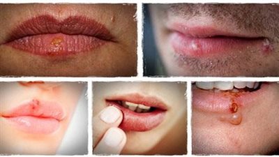 علاج قرح البرد في المنزل و تخلص من شكلها المزعج بسرعة